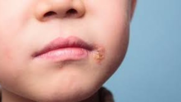 الهربس عند الأطفال.. كيف تميّز أعراض المرض وسط تشابهها مع نزلات البرد؟