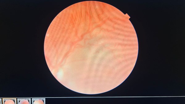 لأول مرة .. رمد المنصورة تنجح في تصوير قاع عين حديث الولاده بتقنية OCT