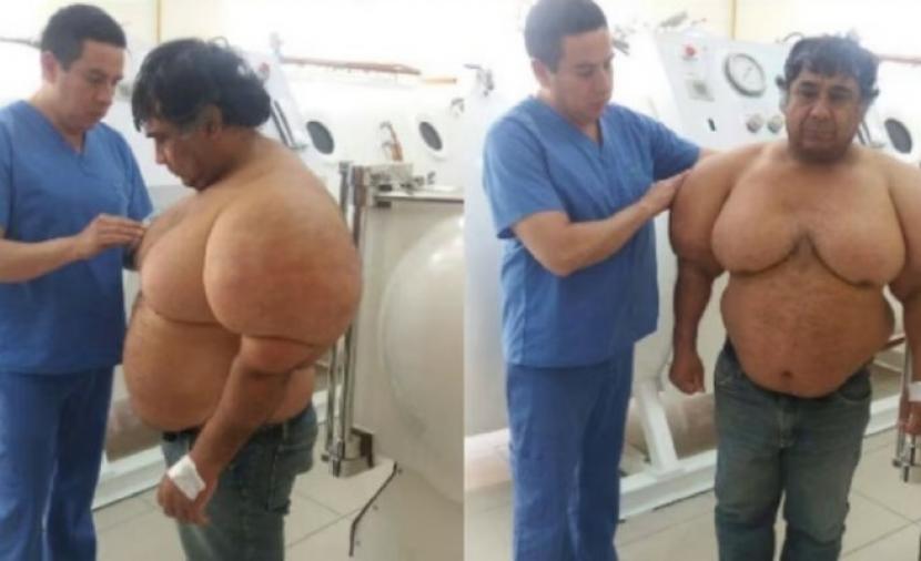 حالة طبية نادرة.. غوّاص بيروفي يتحول إلى “بالون”