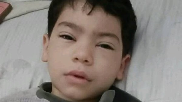 تطورات الحالة الصحية لطفل باسوس المصاب بطلق خرطوش في القليوبية